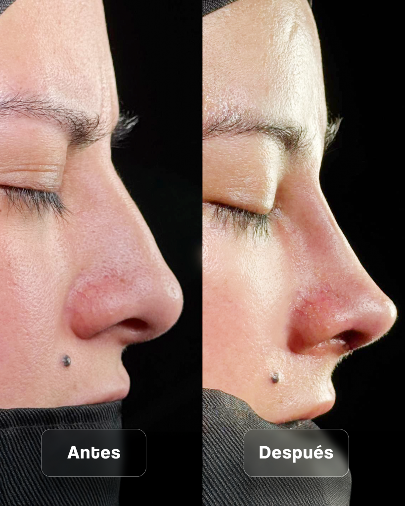 ANTES Y DESPUES RINOPLASTIA_09