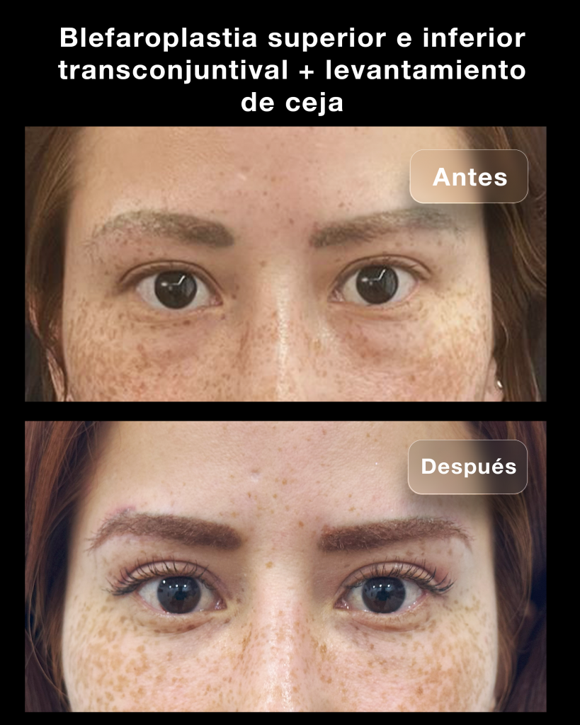 BLEFAROPLASTIA 08