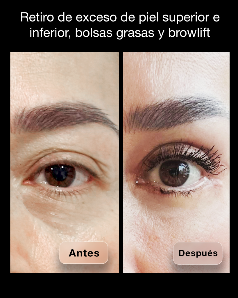 BLEFAROPLASTIA 09