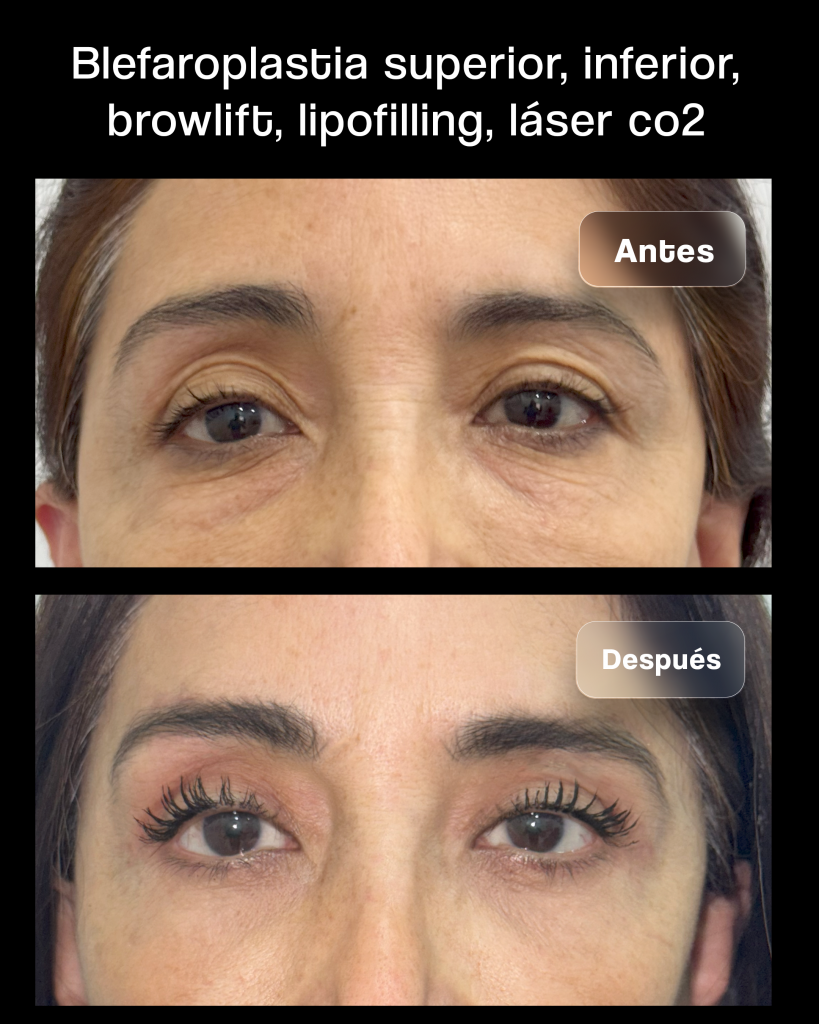 Blefaroplastia Antes y Después 03