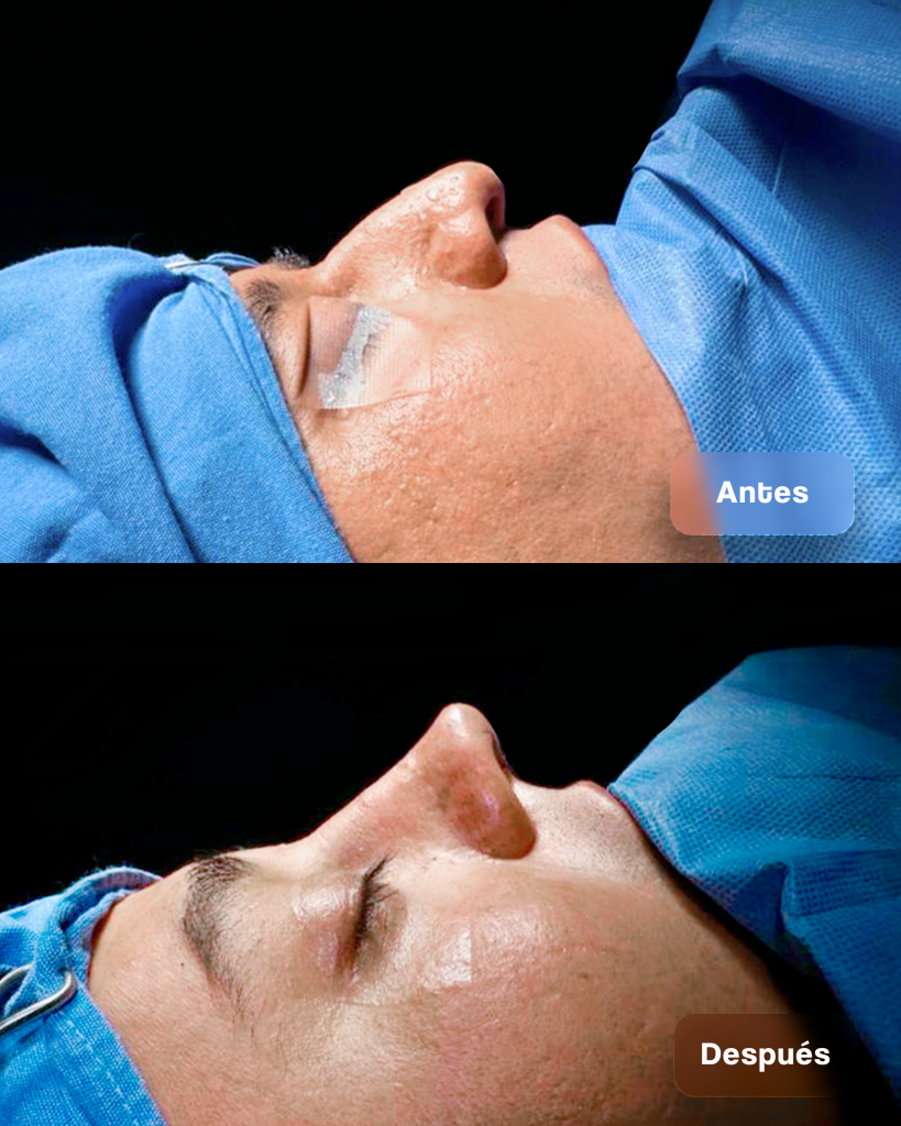 RINOPLASTIA 07_POST 4-5
