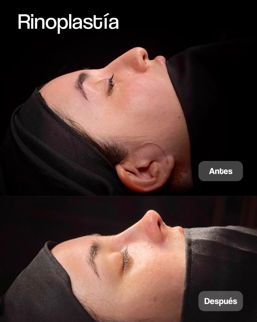 RINOPLASTIA 09_1