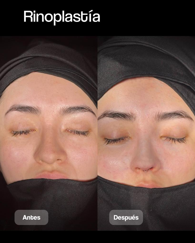RINOPLASTIA 09_2