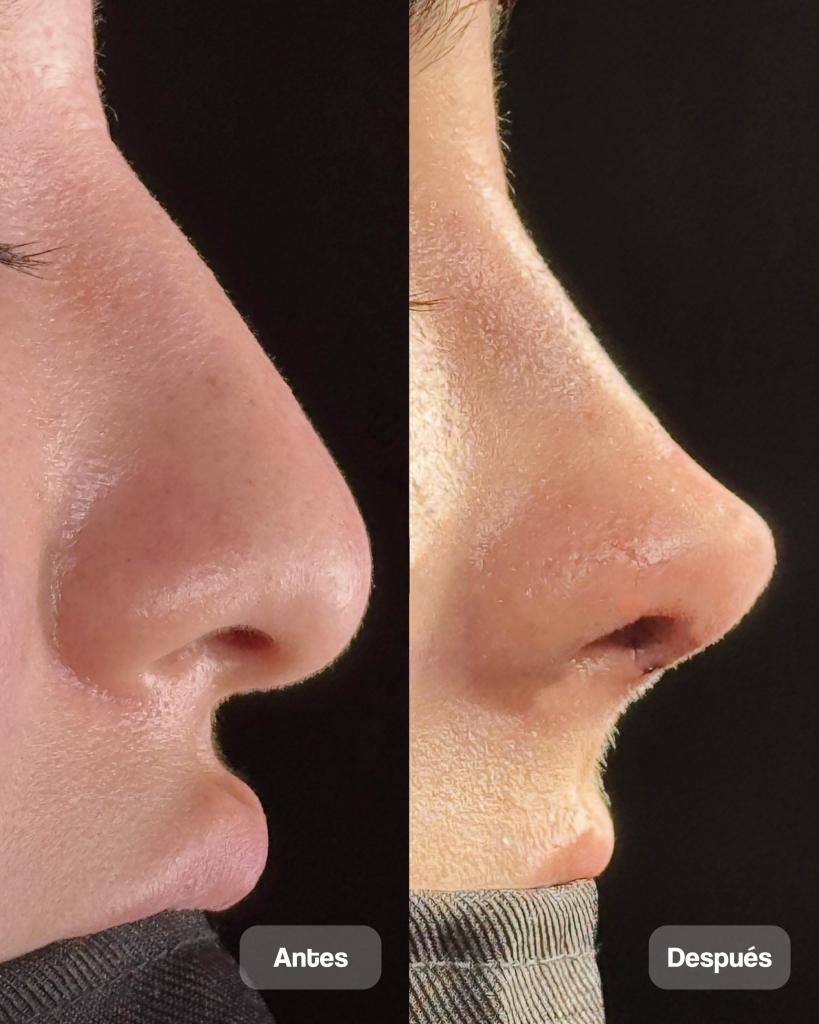 RINOPLASTIA 09_3